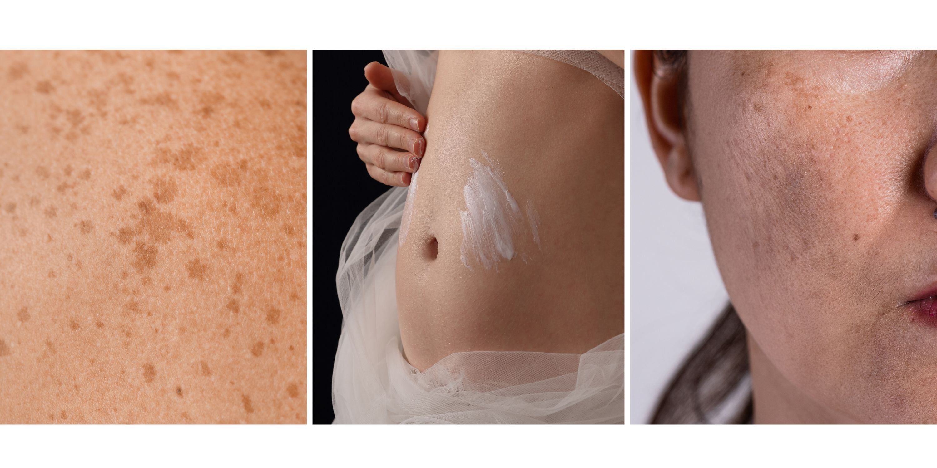 Hyperpigmentation During Pregnancy: Causes, Safe Treatments, and Prevention 111SKIN Hyperpigmentation During Pregnancy: Causes, Safe Treatments, and Prevention 111SKIN