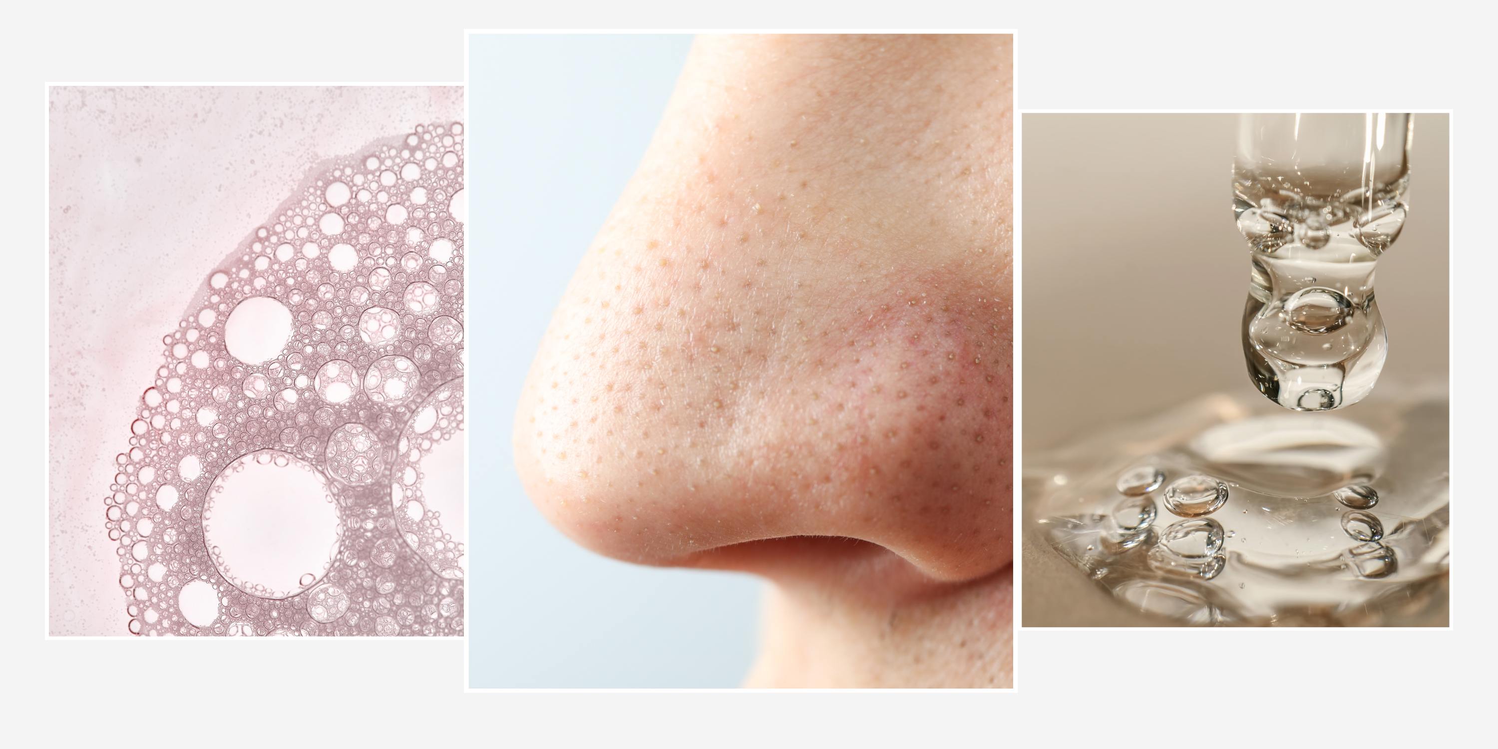 What Causes Open Pores on Nose: Top Reasons & Easy Fixes